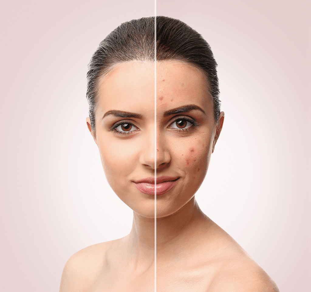 before and after picture of a woman with acne on her face after receiving acne treatment at Kontour
